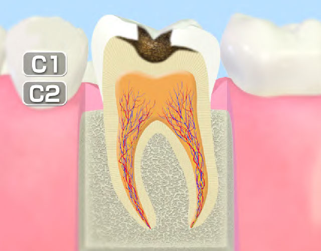 進行したむし歯