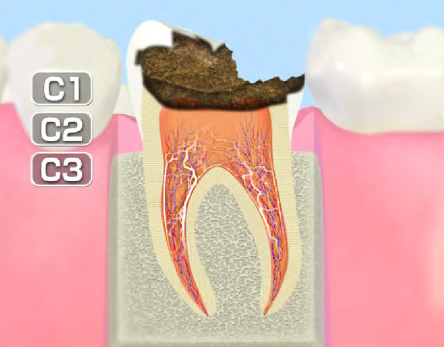 歯髄まで進行したむし歯