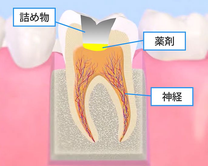 神経を取らない治療