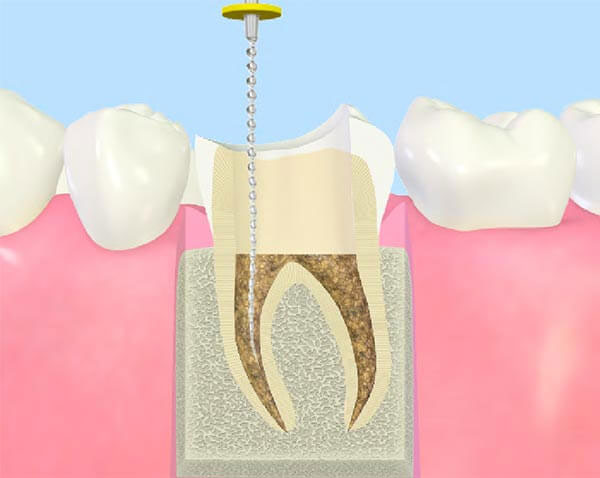 歯の根の治療