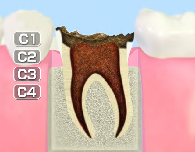 歯質が失われた歯