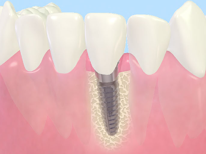 インプラント
