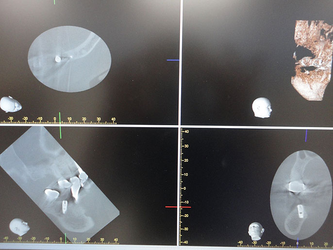 CTによるインプラント埋入位置の確認