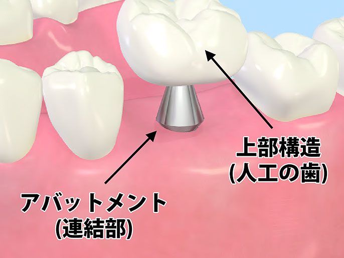 人工歯の装着