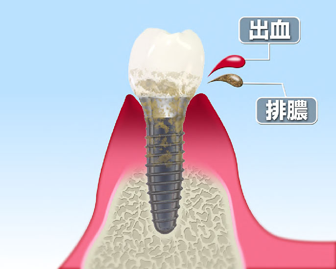 インプラント周囲炎