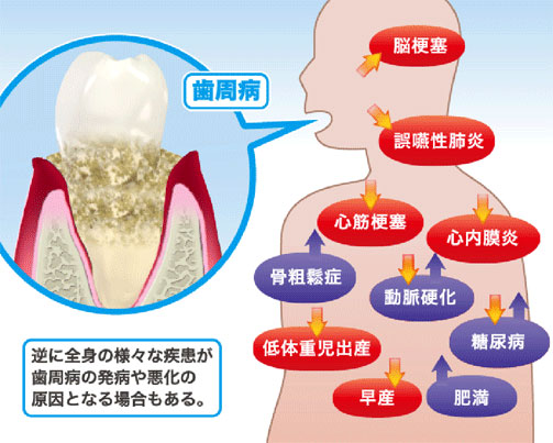 歯周病と全身疾患の関係